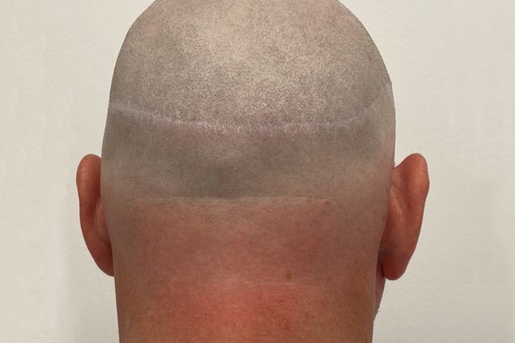 Male & Female Scar Camouflage Treatment 